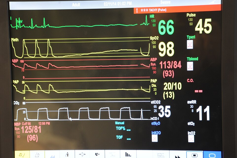 A hospital vital-signs monitor showing heart rate, oxygen saturation and blood pressure traces and numbers